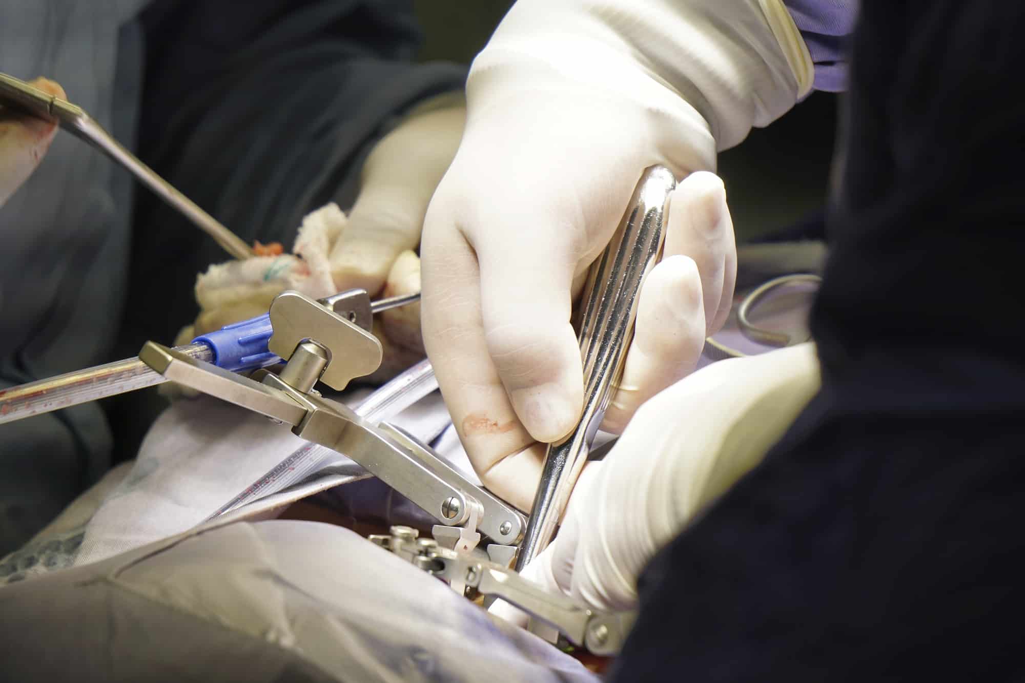 Closeup shot of doctors performing a spinal surgery under the lights - surgical concept